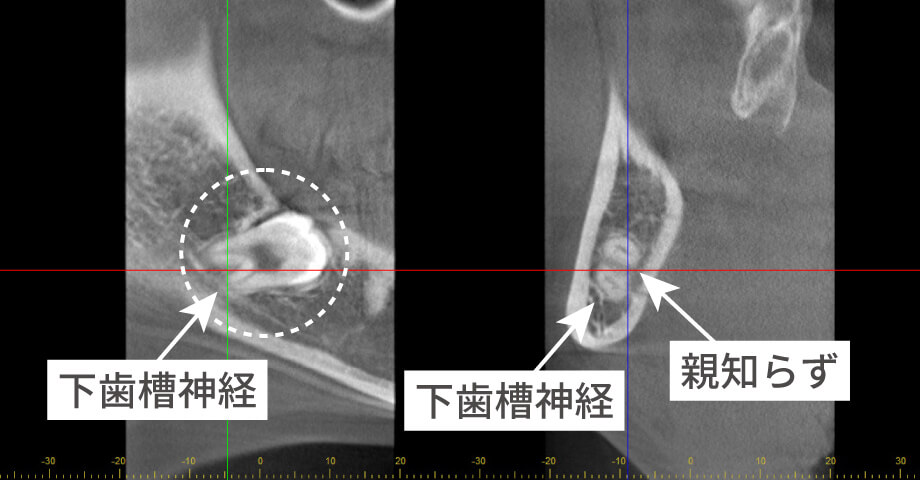 歯科用CT写真